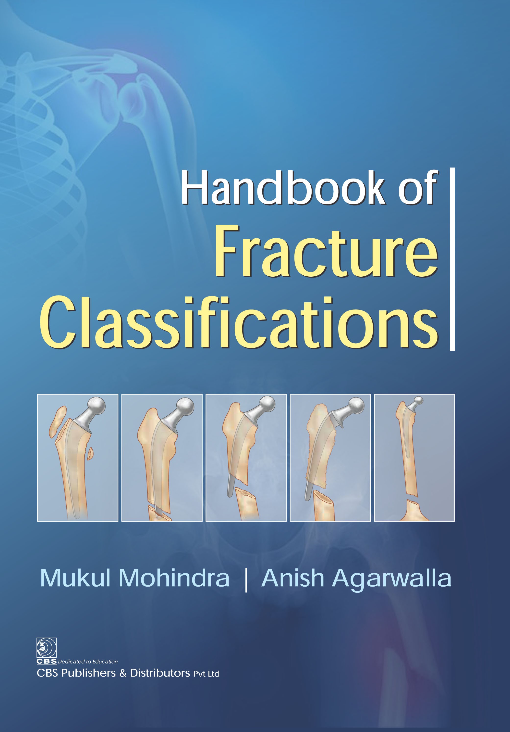 Handbook Of Fracture Classifications (Pb 2017) 