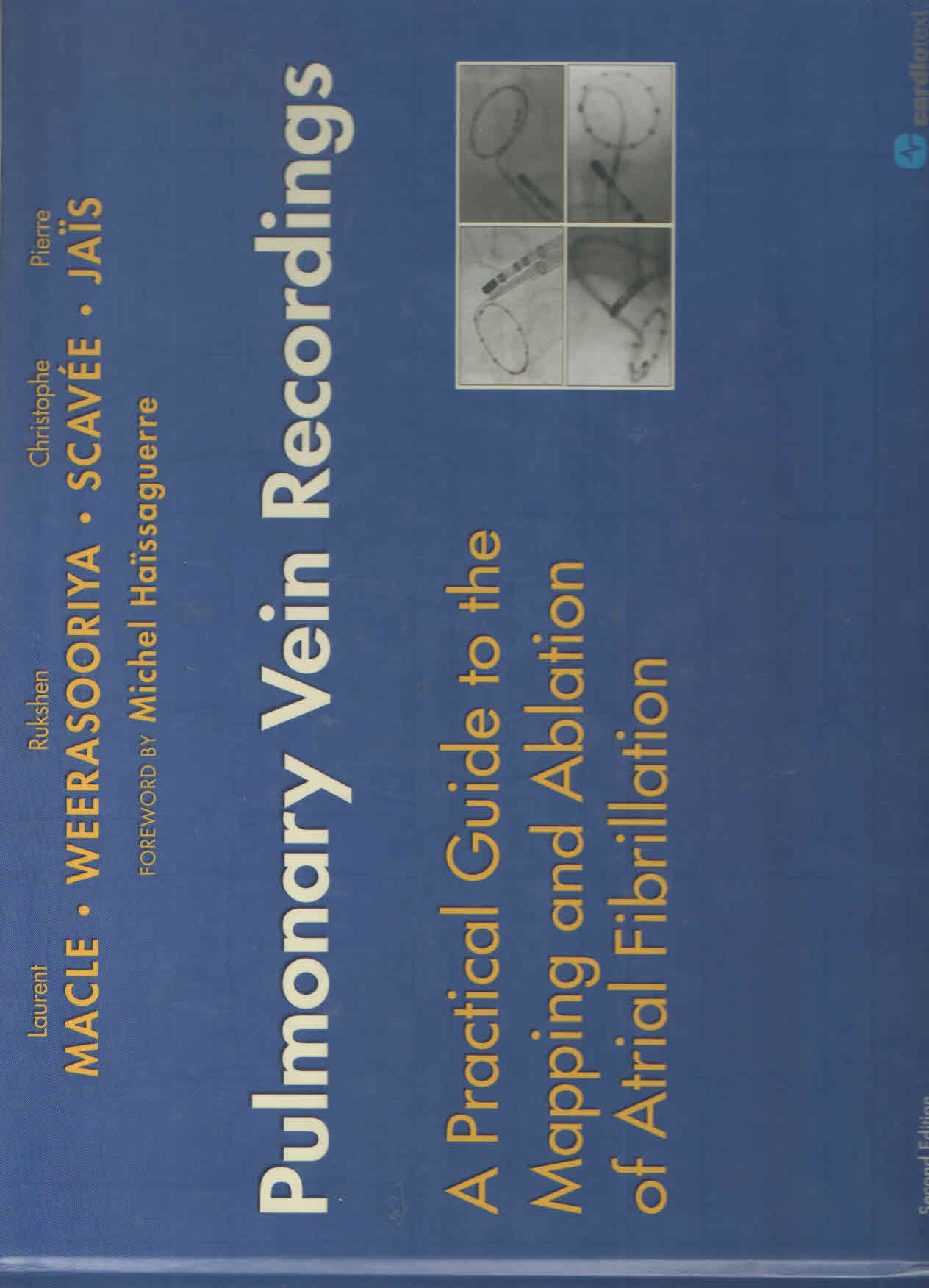 Pulmonary Vein Recordings:A Practical Guide To The Mapping And Ablation Of Atrial Fibrillation