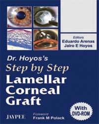 Dr Hoyos’s Step by Step Lamellar Corneal Graft (with DVD-ROM)