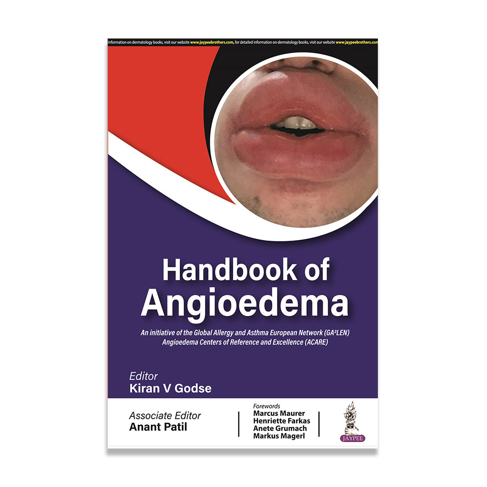 Handbook of Angioedema
