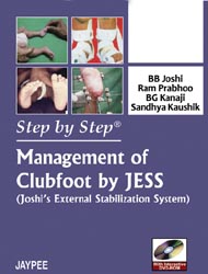 Step by Step Management of Clubfoot by Jess