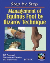 Step by Step Management of Equinus Foot by Ilizarov Technique (with CD-ROM)