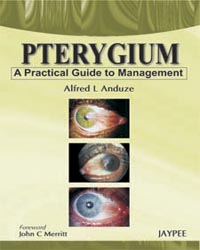 Pterygium: A Practical Guide to Management
