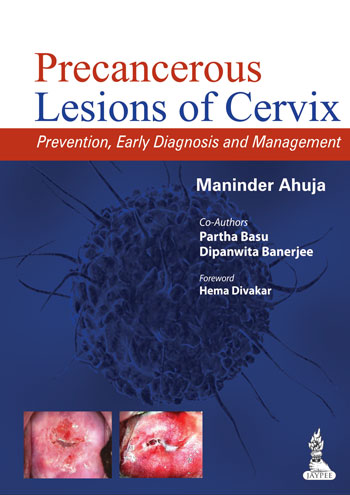 Precancerous Lesions of Cervix Prevention, Early Diagnosis and Management
