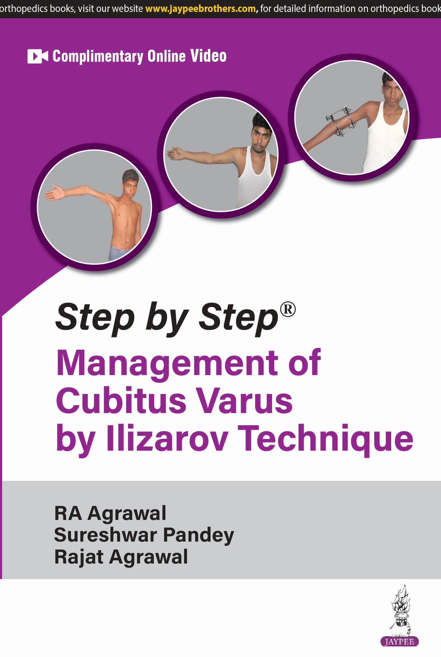 Step by Step Management of Cubitus Varus by Ilizarov Technique