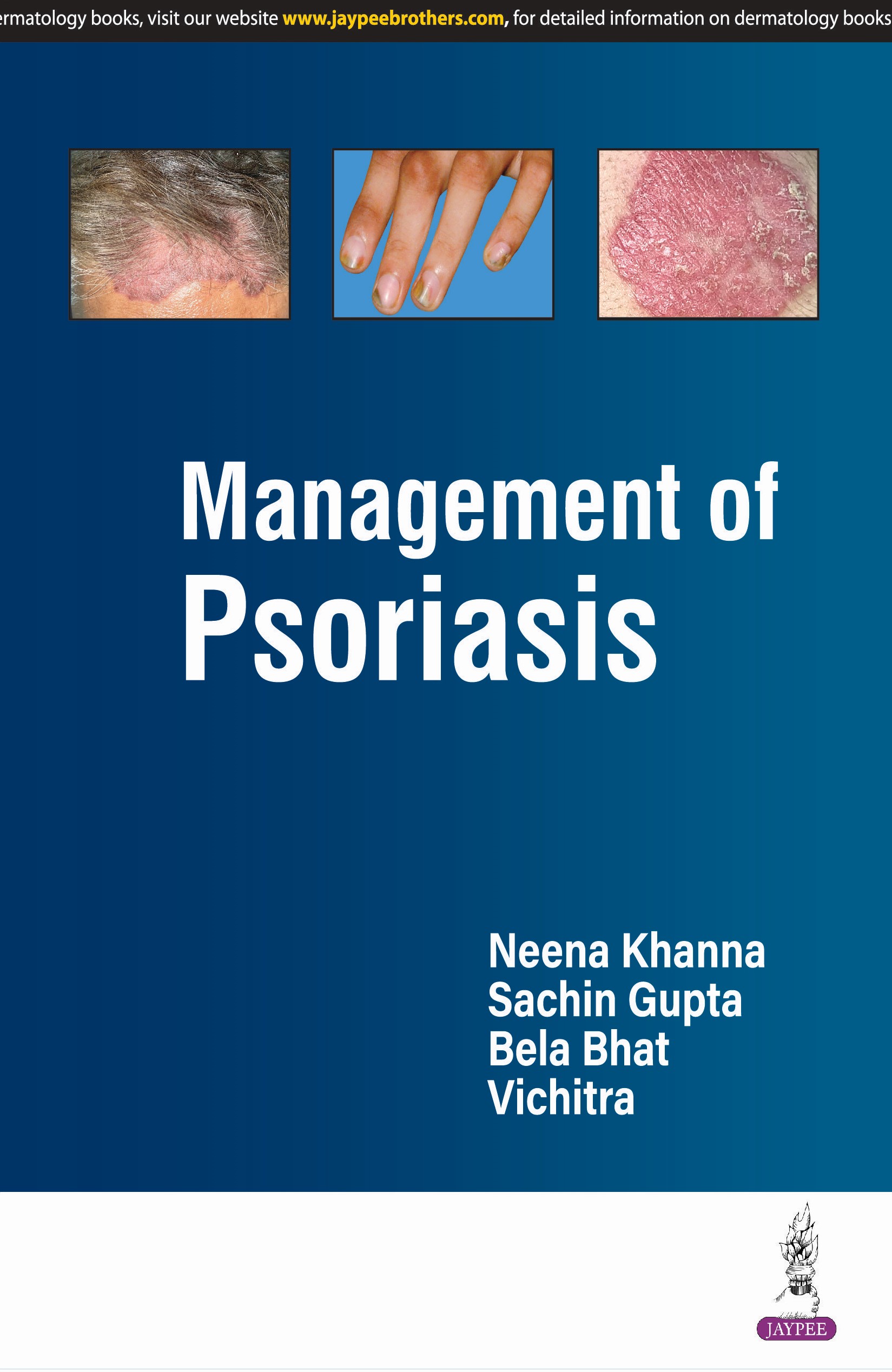 Management of PSORIASIS