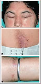 Pocket Atlas Clinical Dermatology