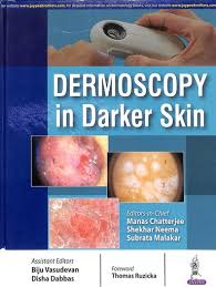 Dermoscopy In Darker Skin