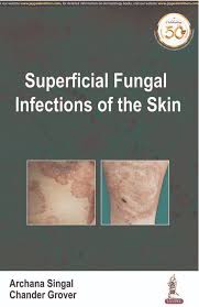 Superficial Fungal Infections of the Skin