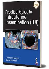 Practical Guide to Intrauterine Insemination (IUI)
